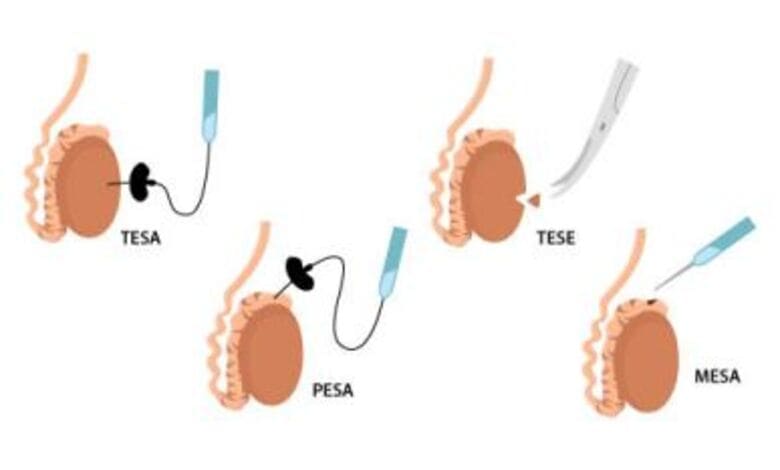 TESE - Екстрация на сперматозоиди от тестисa